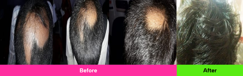 Hair Loss